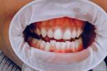 牙龈出血怎么办-牙龈出血怎么预防
